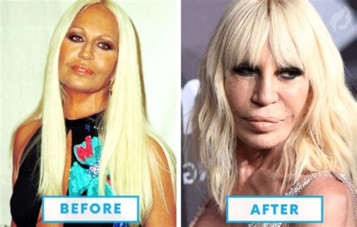 10 Cases of Celebrity Plastic Surgery Gone Wrong Page 3