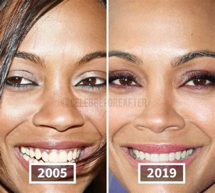 Celebrity Zo&euml; Saldana Nose Job