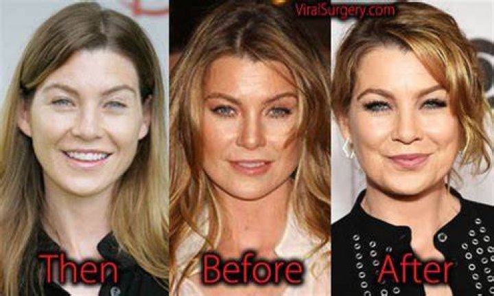 Ellen Pompeo facelift before and after Facelift before and after