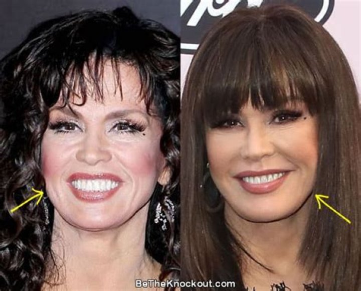 Has Marie Osmond Gotten Plastic Surgery? Our Experts Weigh In!