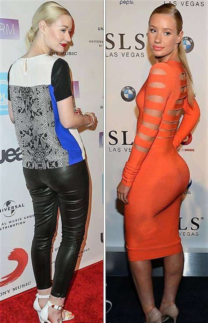 Iggy Azalea, Butt Implant Plastic Surgery, Before & After Butt