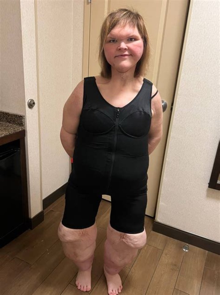 Is Tammy Slaton' Forehead Abnormal? Medical Condition Explained! Did