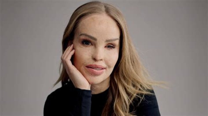 Katie Piper Net Worth, Bio, Height, Family, Age, Weight, Wiki 2023