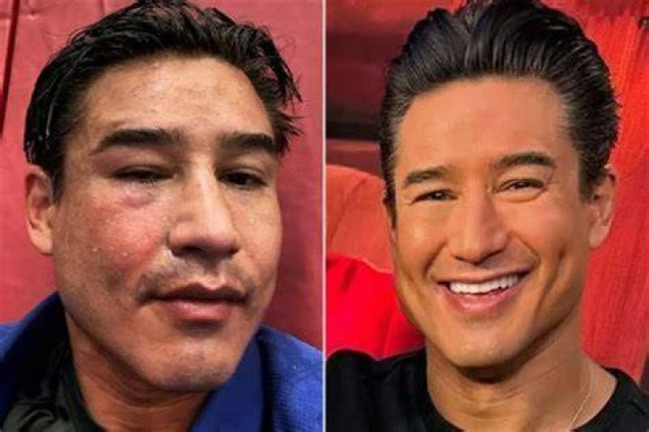 Mario Lopez Sick His Illness And Health 2023