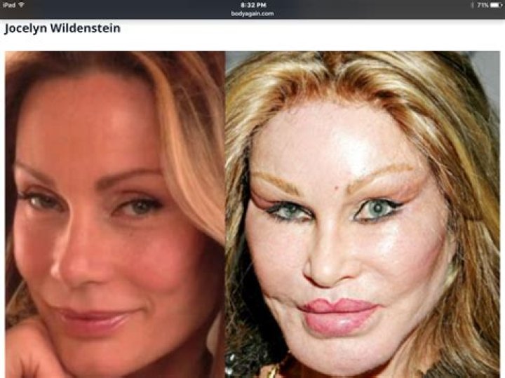 Pin on Celebrity Plastic Surgery