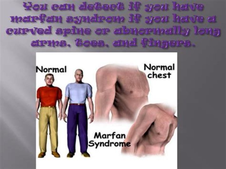 PPT MARFAN SYNDROM PowerPoint Presentation, free download ID2113007
